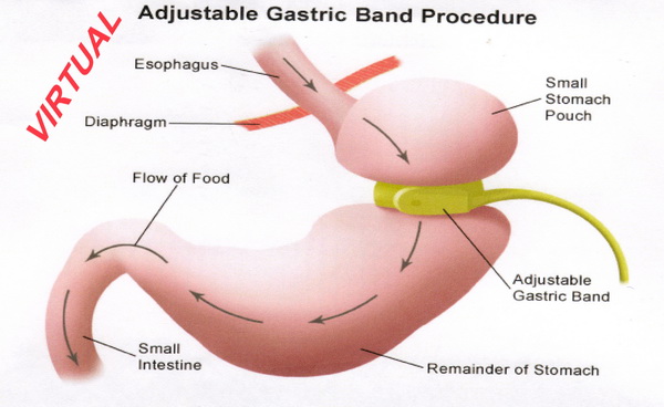 /Virtual Gastric Band