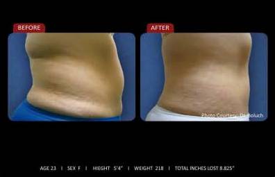Zerona Results 1 | Synergy Massage & Personal Fitness