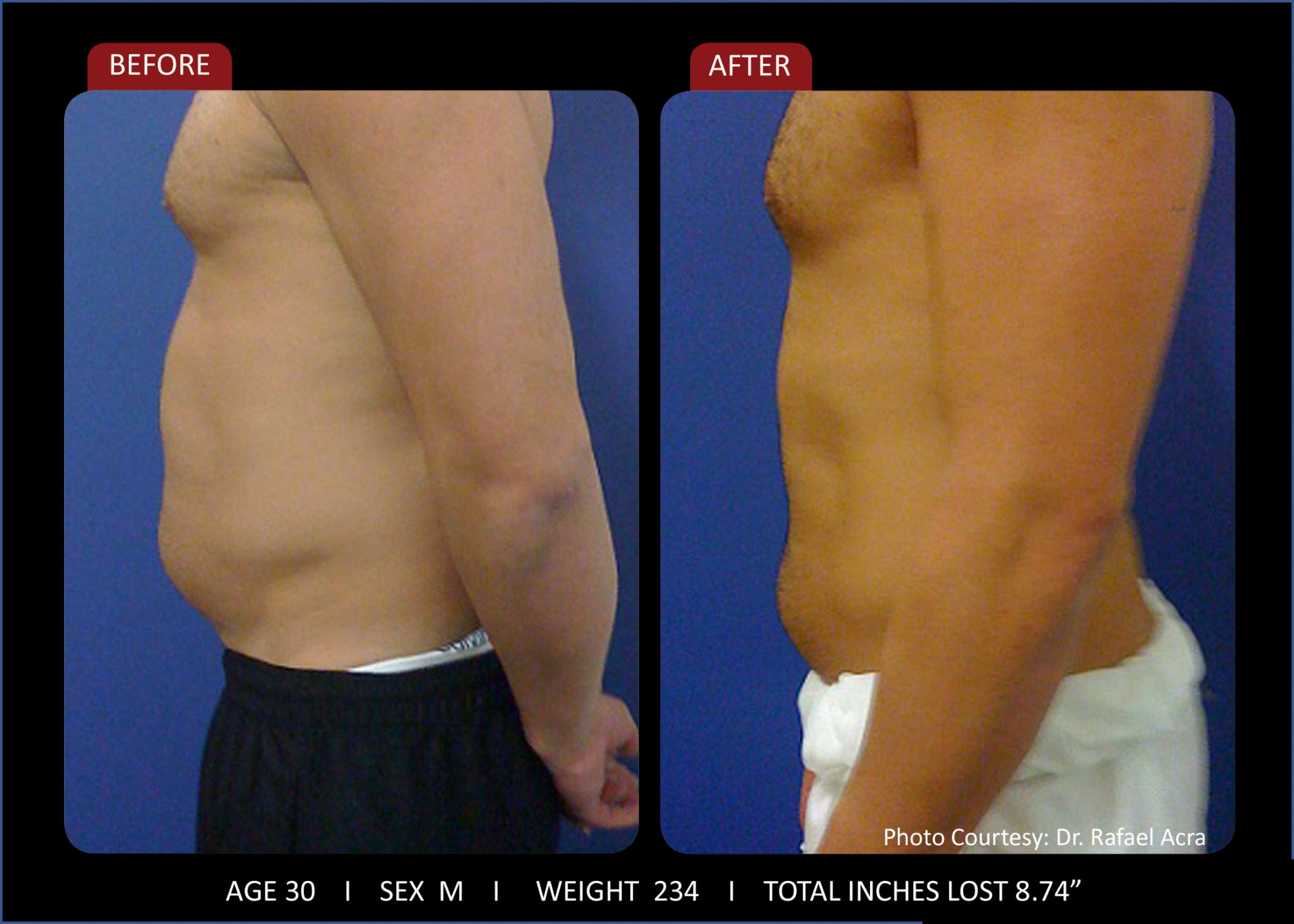 Zerona Results 2 | Synergy Massage & Personal Fitness
