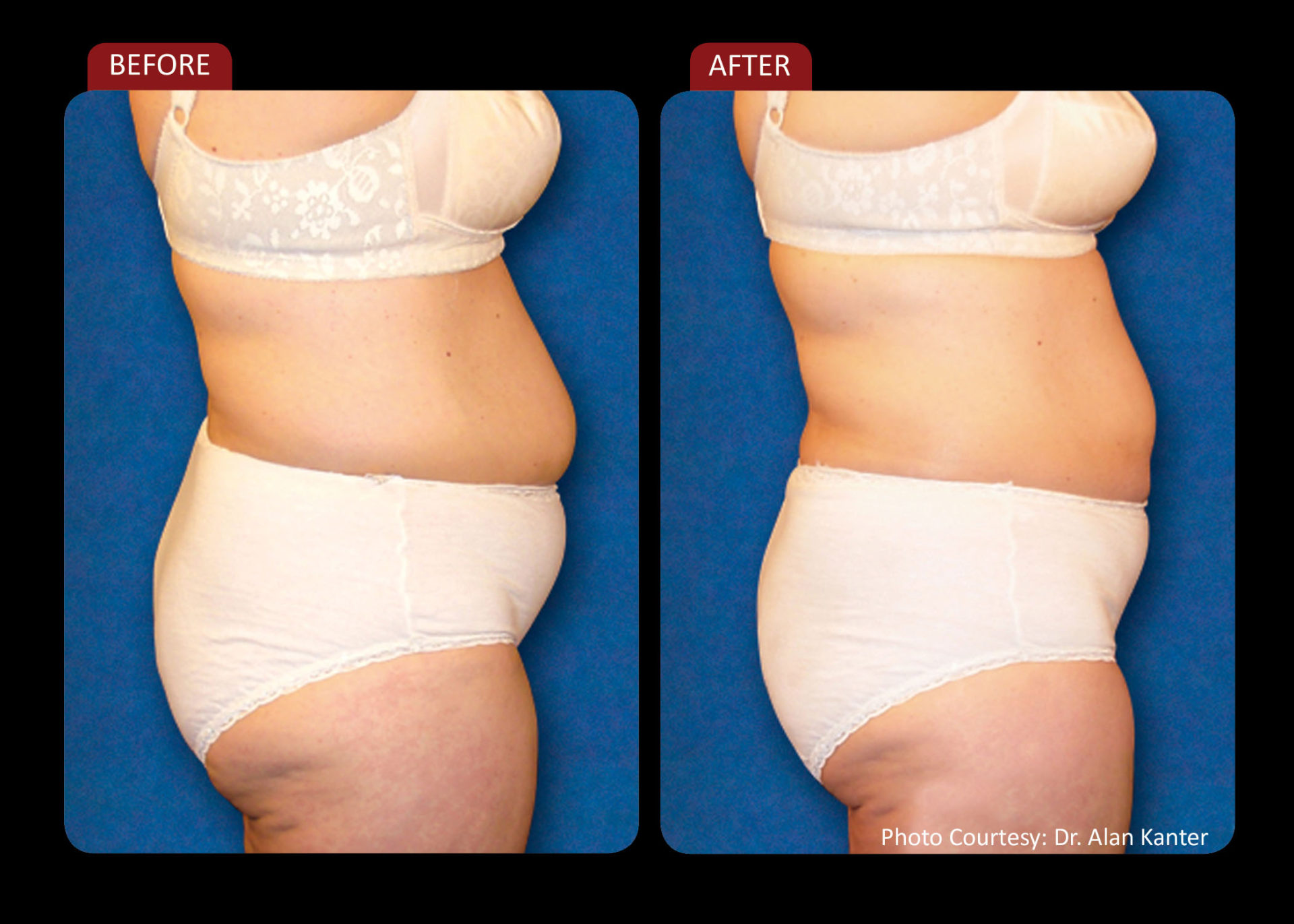 Zerona Results 3 | Synergy Massage & Personal Fitness