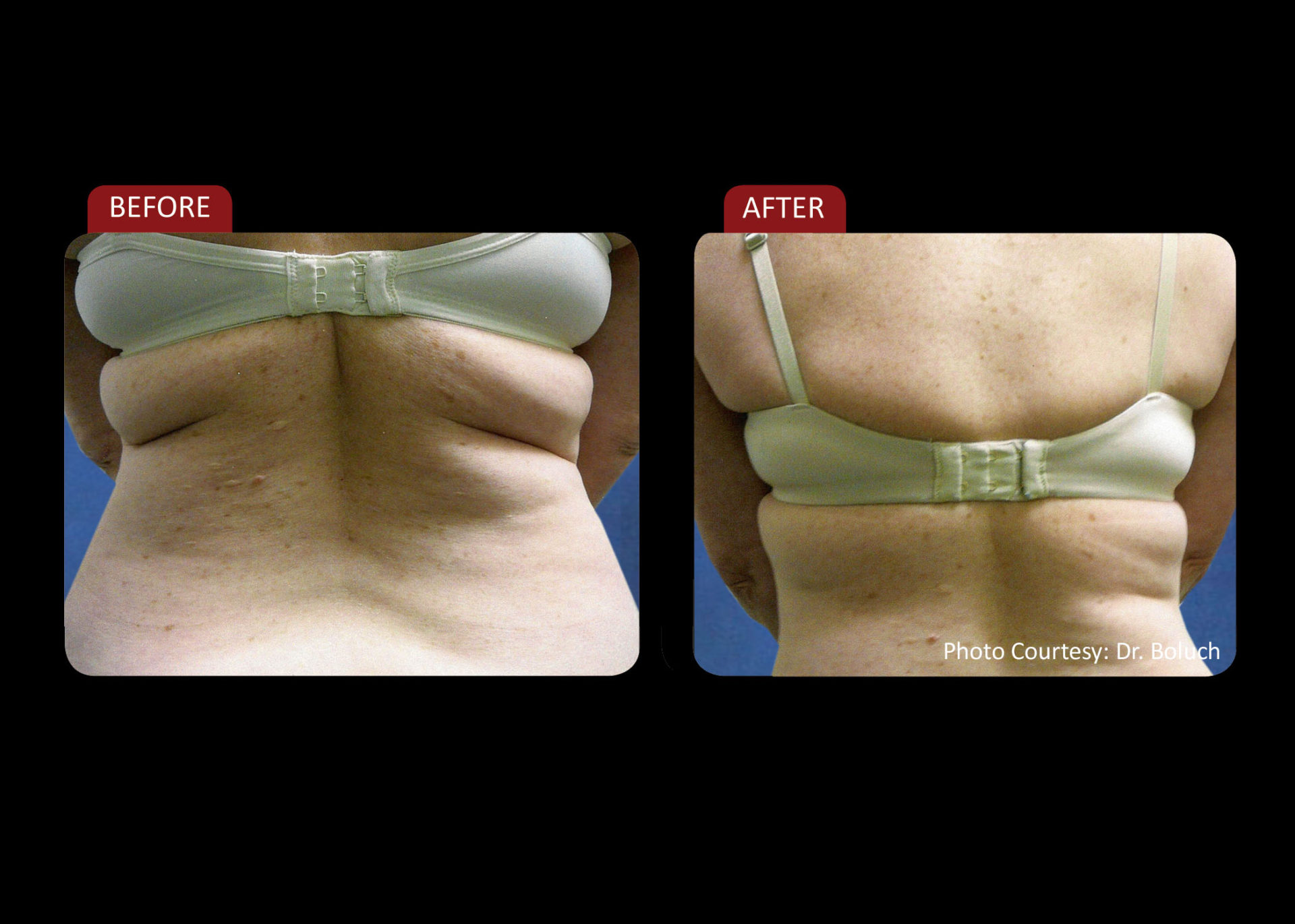 Zerona Results 4 | Synergy Massage & Personal Fitness