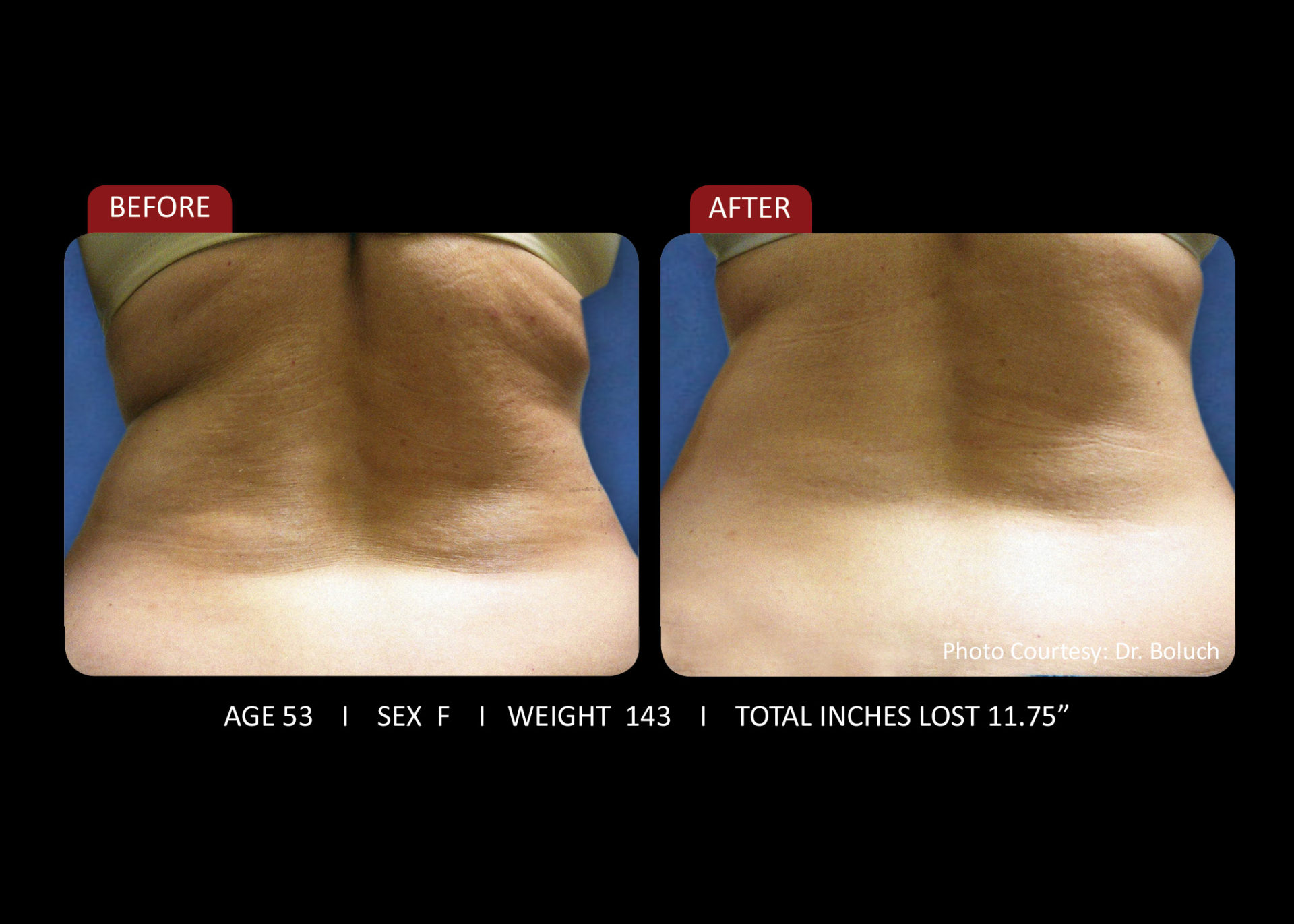 Zerona Results 5 | Synergy Massage & Personal Fitness