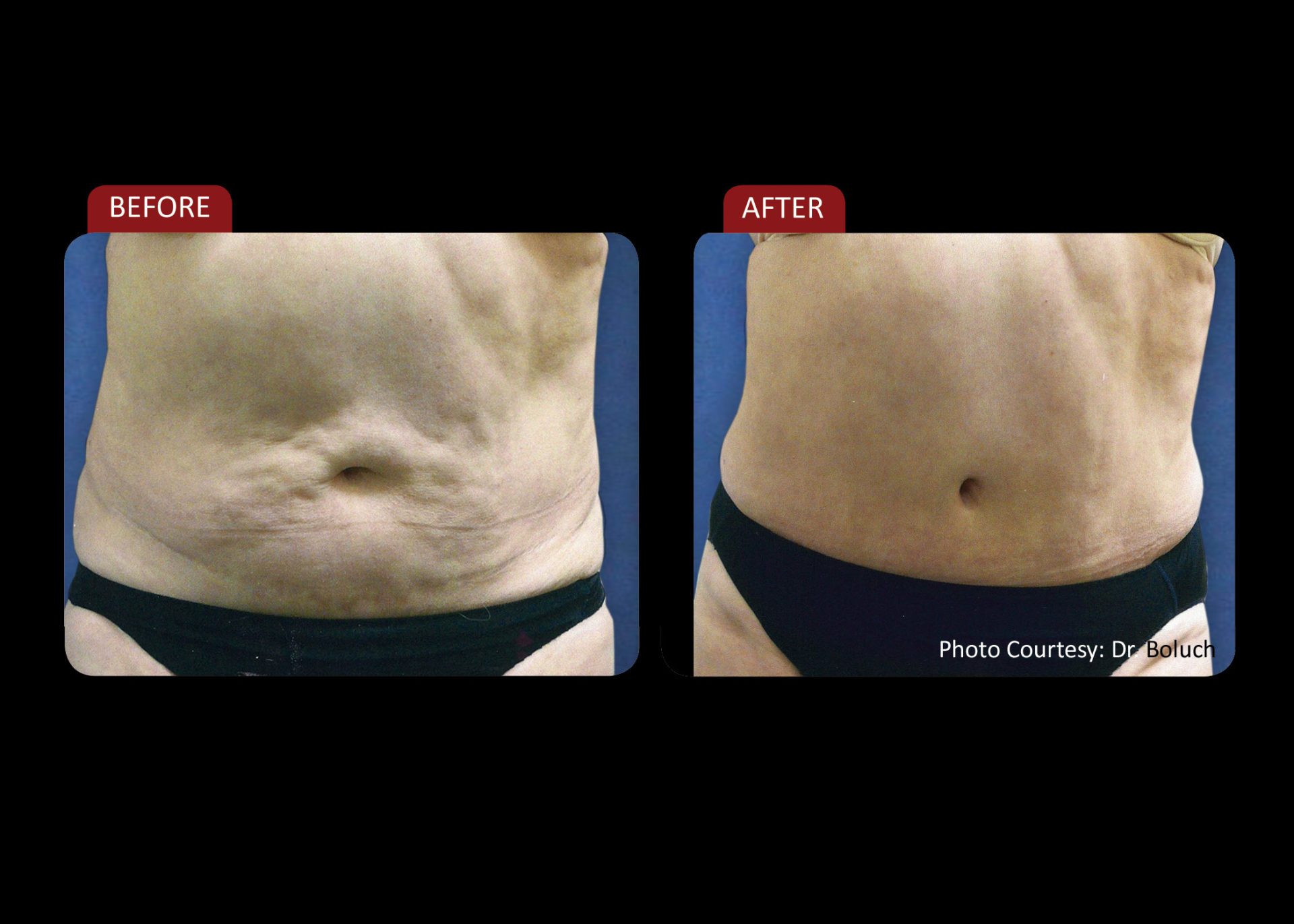 Zerona Results 6 | Synergy Massage & Personal Fitness
