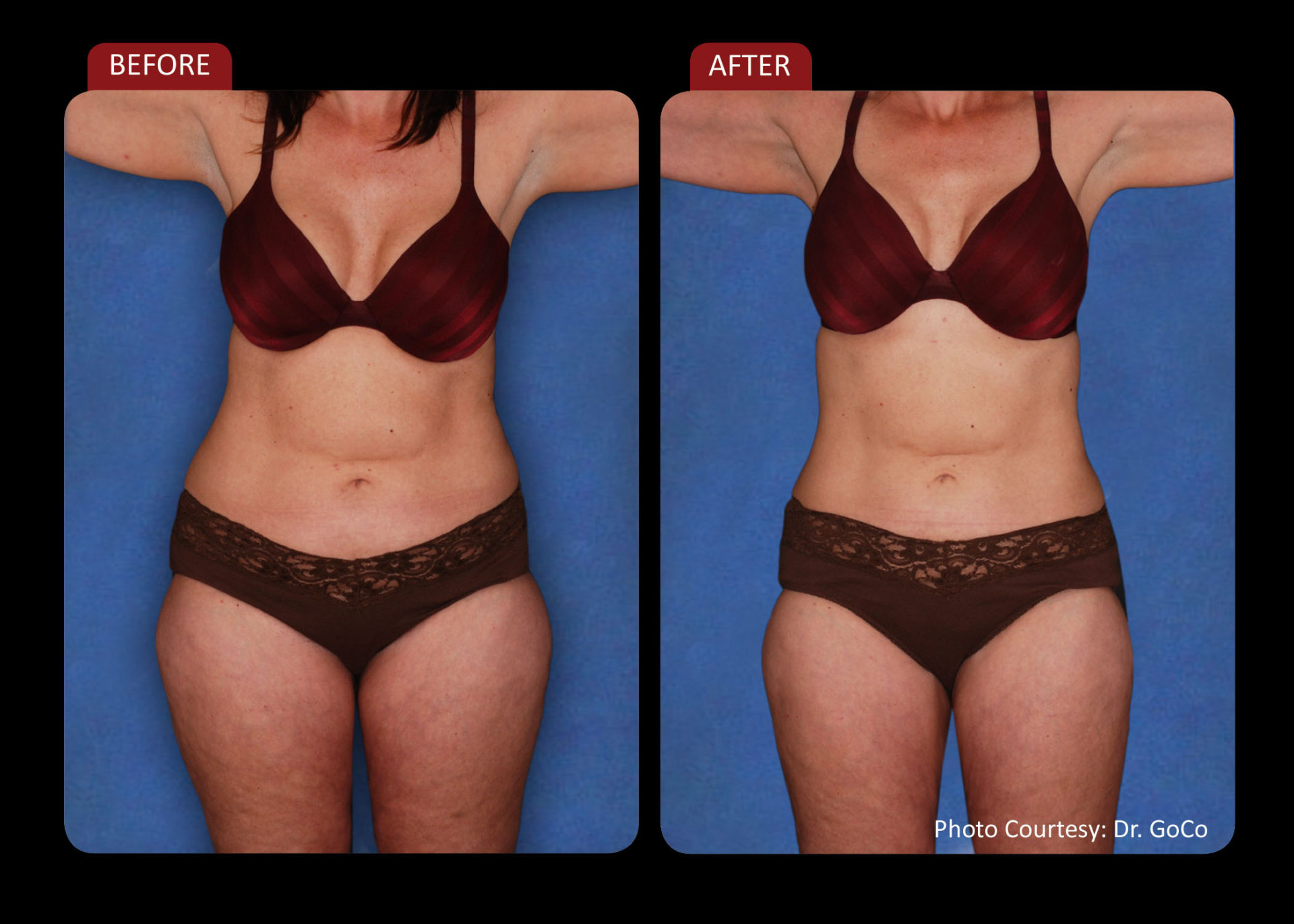 Zerona Results 7 | Synergy Massage & Personal Fitness