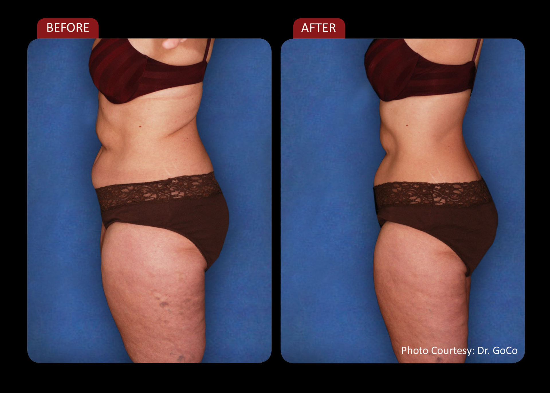 Zerona Results 8 | Synergy Massage & Personal Fitness