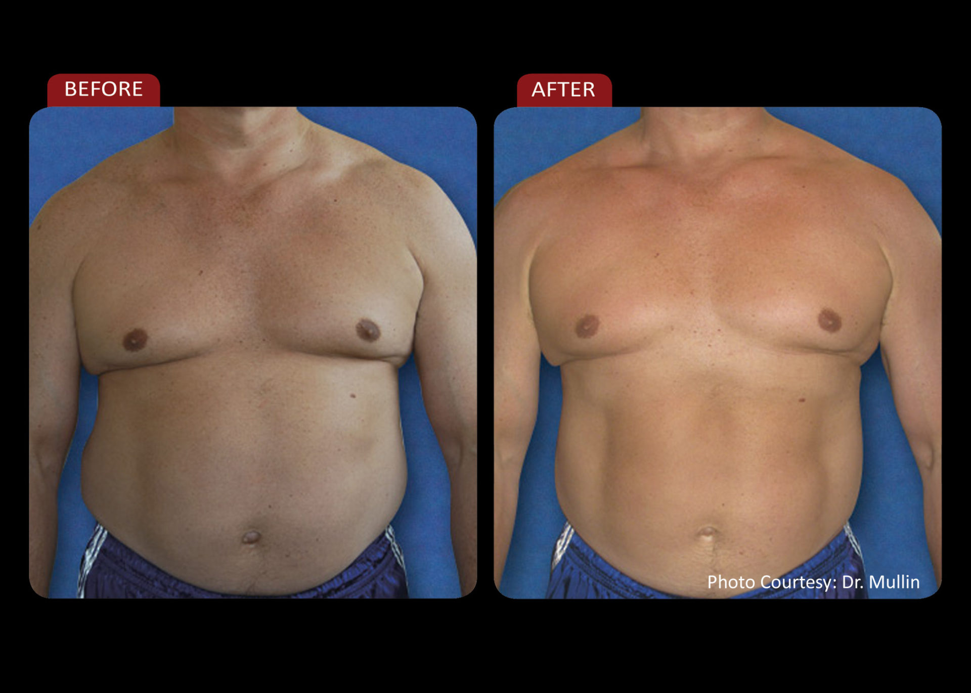 Zerona Results 9 | Synergy Massage & Personal Fitness